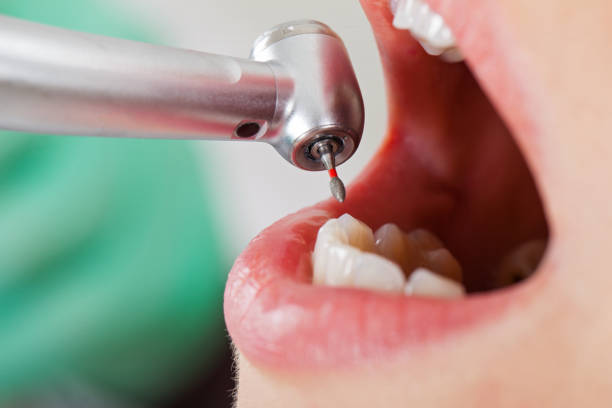Best Emergency Treatment for Dental Infections or Abscesses in Bristol, VA